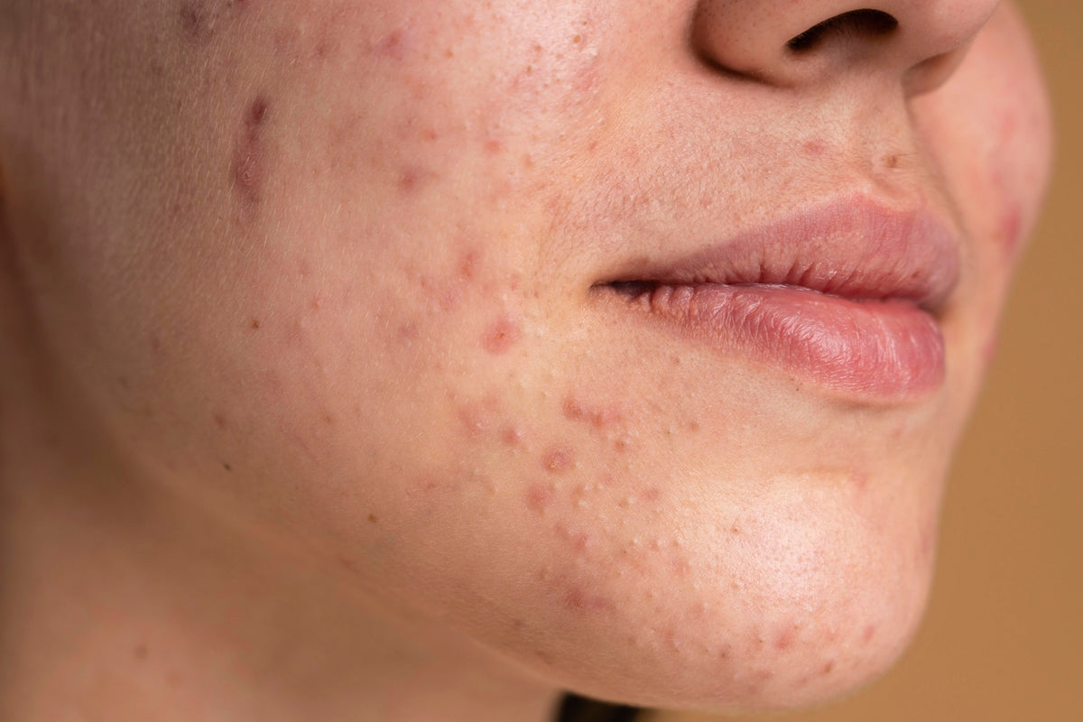 co2-Acne