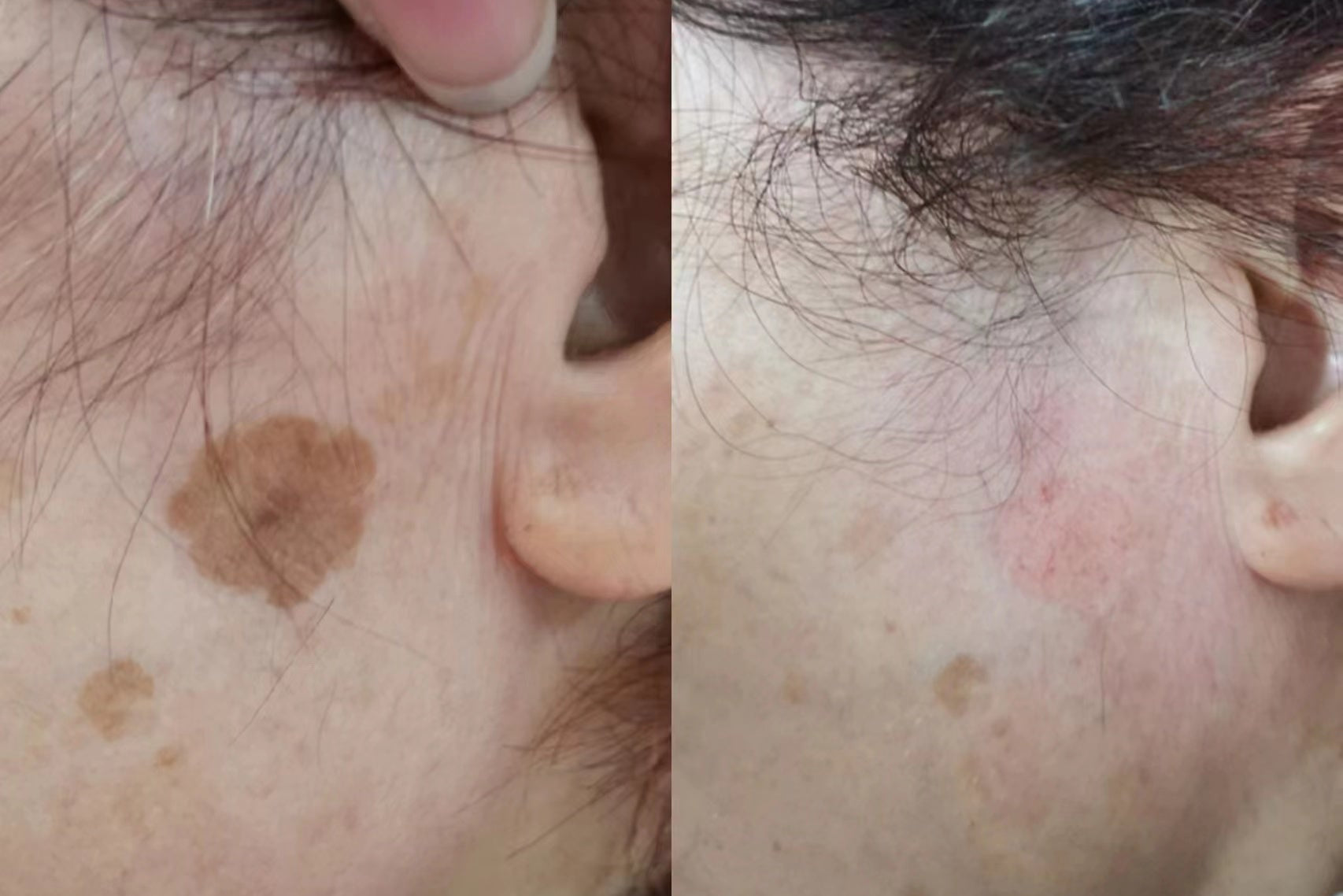 pico-pigmented-lesion