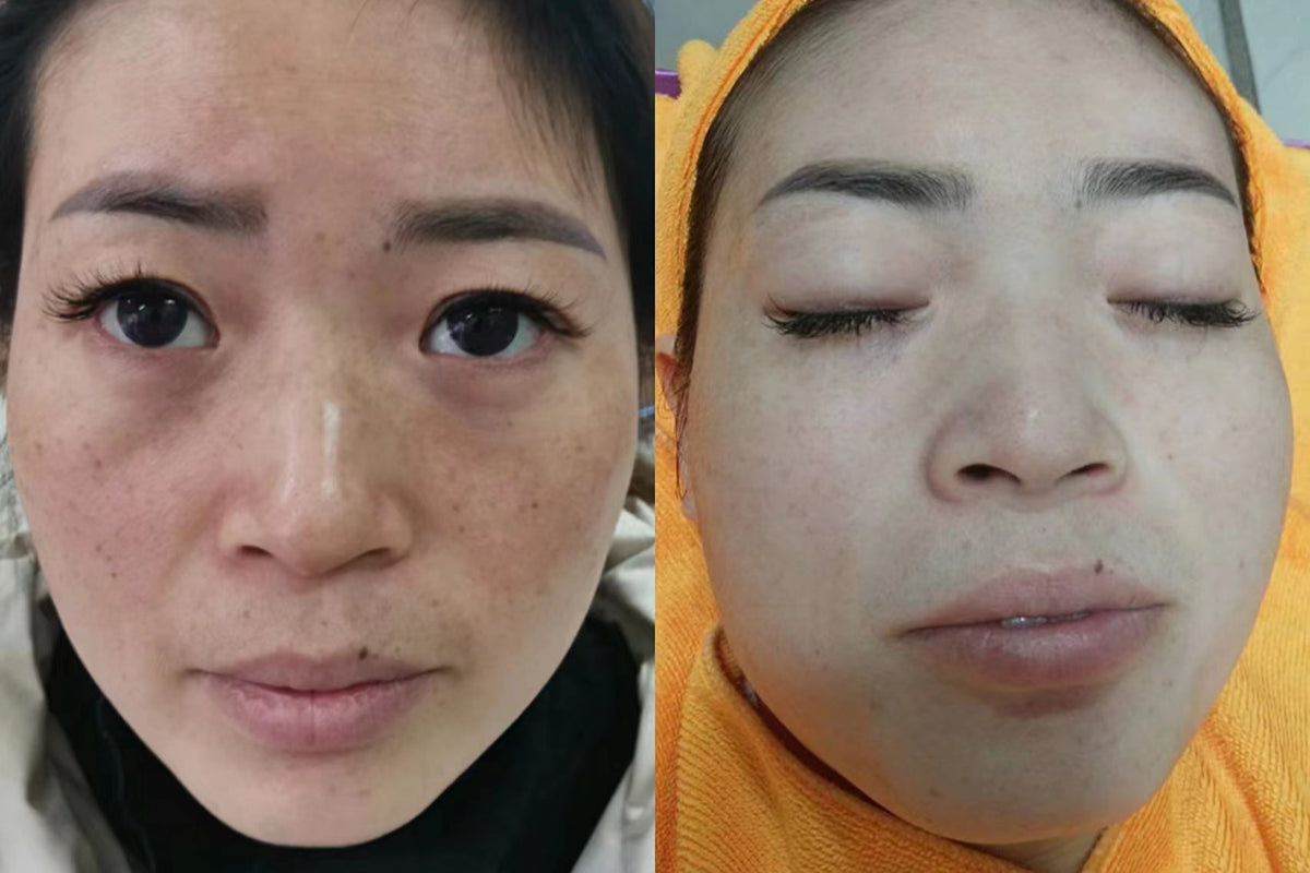 pico-Skin-Rejuvination