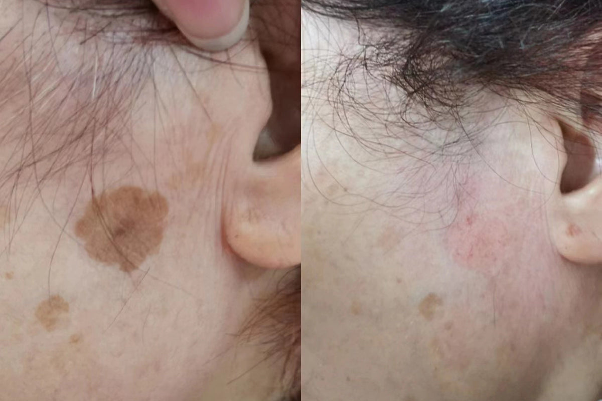 pico-pigmented-lesion